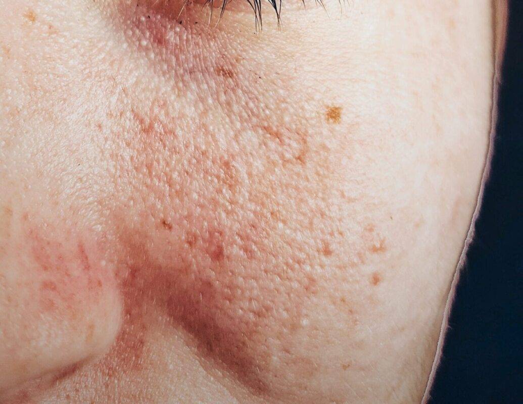 علاج التهاب الوجه بعد التشقير