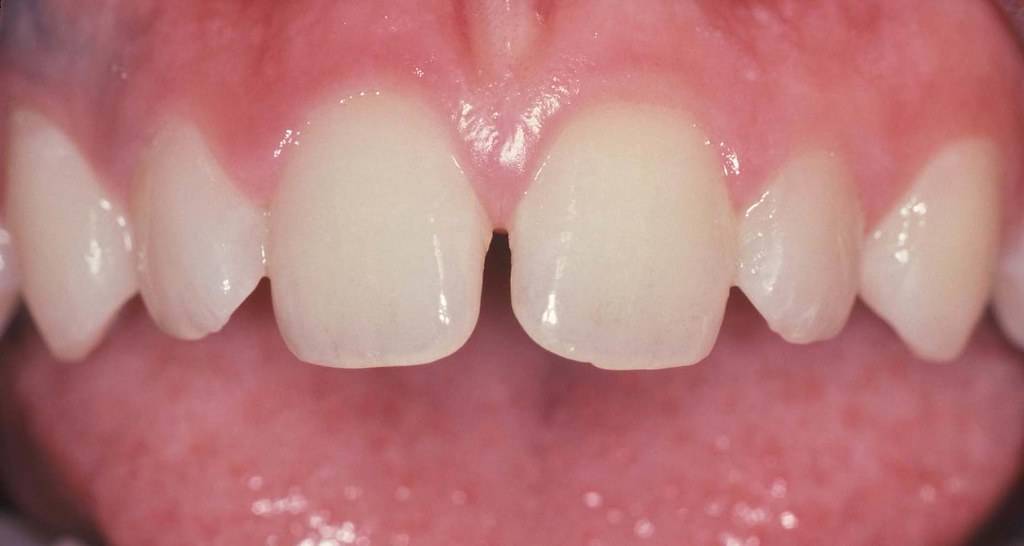 تسوس الاسنان الامامية وعلاجها