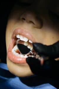 ما هو تسوس الاسنان
