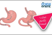 تجارب تكميم المعدة